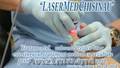 Лазерное лечение онихомикоза в Молдове Лазерное лечение оникомикоза (грибок ногт