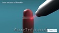 Circumcizie  cu laser  la barbati: ușor,  rapid și fără durere!  