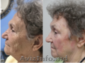  Tratament cu laser regenerarea pielii si eliminarea ridurilor in cabinetul de c