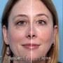 Blefaroplastie cu laser (Chirurgia laser estetica a pleoapelor) in (Chisinau) Mo